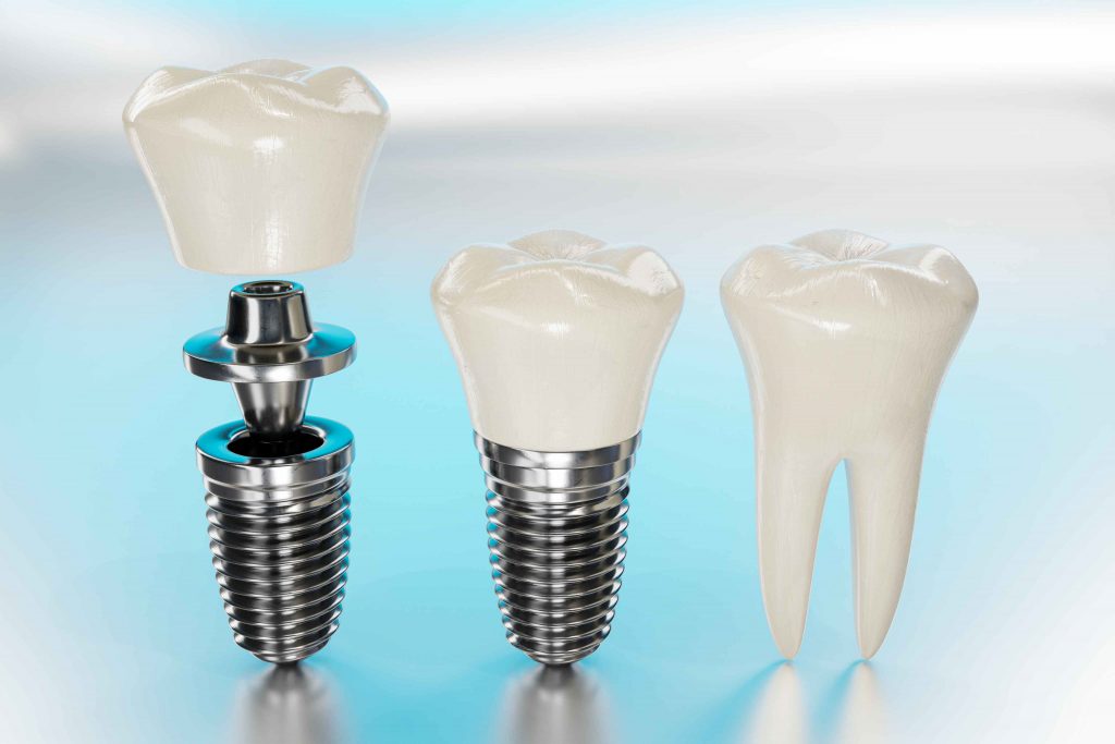 Affordable Dental Implants Costa Mesa, CA | Urgent Dentistry