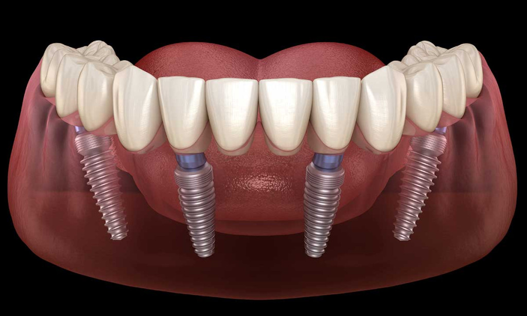 How to Choose the Right Cosmetic Dentist for All-on-4 Implants?